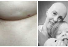 Publicó una foto mostrando un síntoma de cáncer que muchos pasan por alto