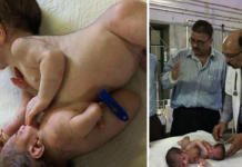 El impresionante caso de un gemelo «parásito» que fue extirpado del cuerpo de su hermano