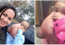 Melyssa, de 3 años, estuvo al borde de la muerte por un tumor en su rostro de más de 2 Kg