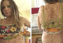 Vive 25 años con 6 mil tumores sobre su piel hasta que un tratamiento cambió su vida