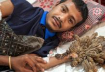 Cambia la suerte del «hombre árbol» tras las 16 cirugías que le devolvieron la esperanza