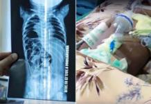 Los médicos descubren 16 agujas de coser dentro del cuerpo de un bebé de 11 meses