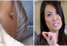 Una doctora extrae un “absceso” a una paciente y descubre que tiene vida propia