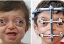 Un médico logra transformar su rostro desfigurado por un extraño síndrome