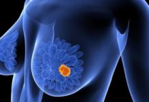 Una nueva técnica tratará el cáncer de mama en una sola sesión de radioterapia en España