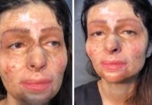 Por primera vez se vio maquillada desde que su rostro quedó desfigurado a los 11 años