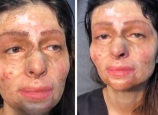 Por primera vez se vio maquillada desde que su rostro quedó desfigurado a los 11 años