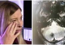 Un dolor de cabeza fue la alerta mortal para descubrir lo que se escondía en su cerebro