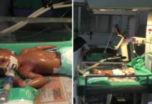 Nace un bebé con una rara condición médica que hace que su piel parezca de plástico