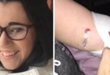 Los médicos no encuentran el implante anticonceptivo atascado en su brazo