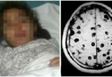 Hallan 100 huevos de tenia en el cerebro de una niña que padecía fuertes dolores de cabeza