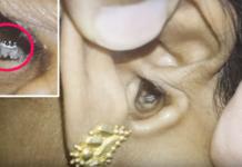 Tenía fuertes dolores de cabeza hasta que descubren una araña viviendo dentro de su oreja