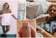 A una joven de 20 años terminan amputándole el dedo pulgar por su hábito de morderse las uñas