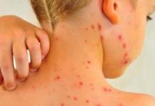 La enfermedad que está a punto de convertirse en una epidemia… ¿Se debe a los antivacunas?