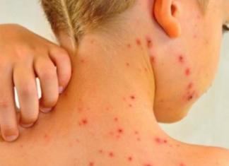 La enfermedad que está a punto de convertirse en una epidemia… ¿Se debe a los antivacunas?