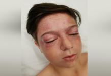 Un peligroso reto viral deja a un pequeño de 11 años con riesgo de un derrame cerebral