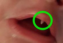 El insólito crecimiento de un colmillo en un bebé de 11 semanas desconcierta a los médicos