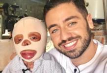 La emotiva historia de Mateo, un niño de 3 años que sobrevive con el 90% de su cuerpo quemado