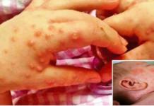 Médicos advierten del peligro del virus de «boca, manos y pies» especialmente para los niños